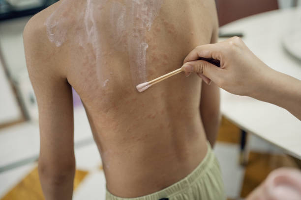 Dalili za fangasi kwa mtoto: Utambuzi, Kinga na Tiba