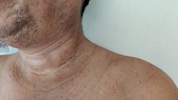 Dalili za mwanzo za ukimwi kwa mwanaume